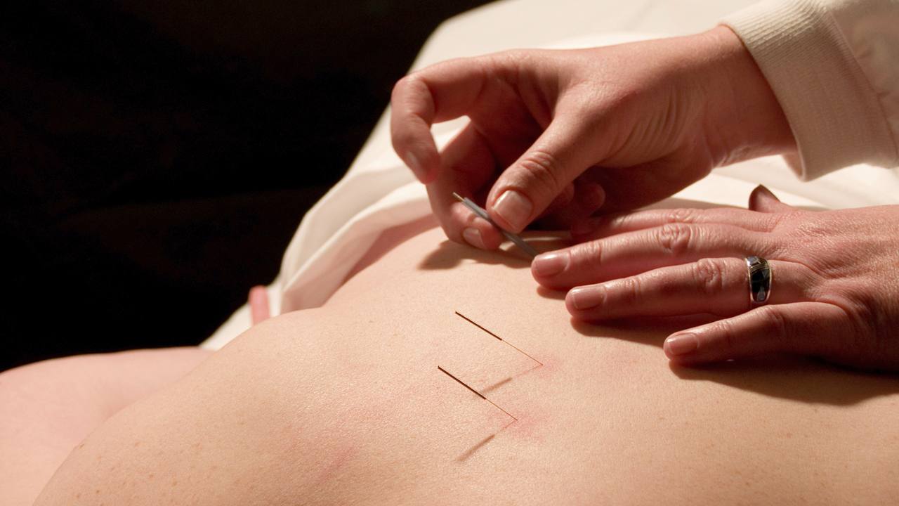 La acupuntura, medicina tradicional china que restablece la energía corporal