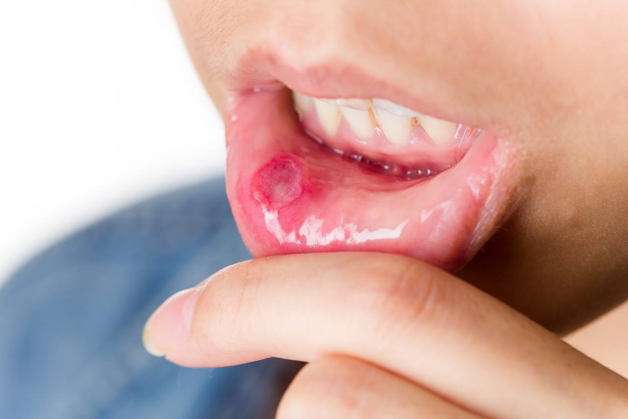 Qué las causa y cómo se tratan las heridas o llagas que aparecen en la boca