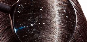 Descamación del cuero cabelludo: cómo evitarla