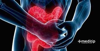 La inflamación intestinal acecha a muchos pacientes reumatológicos