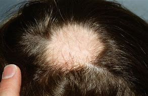 Alopecia, los porqués de la pérdida de pelo