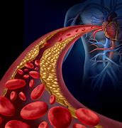 Arterioesclerosis