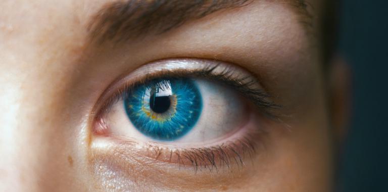 Síndrome de Waardenburg, ojos azul intenso