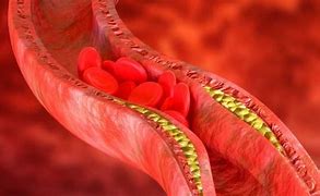 Colesterol malo alto se relaciona con síntomas prolongados de Covid y otras enfermedades: Estudio