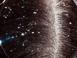 Descamación del cuero cabelludo: cómo evitarla